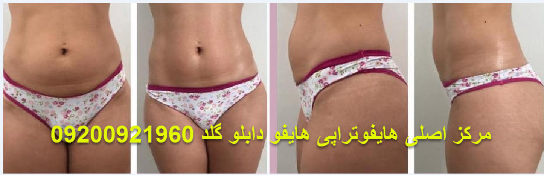 هایفوتراپی .بهترین روش .جهت رفع چین و چروک صورت و بدن