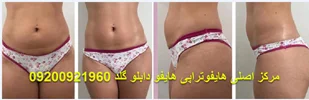 هایفوتراپی .بهترین روش .جهت رفع چین و چروک صورت و بدن