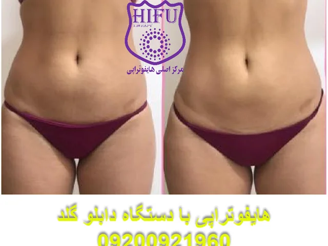 هایفوتراپی