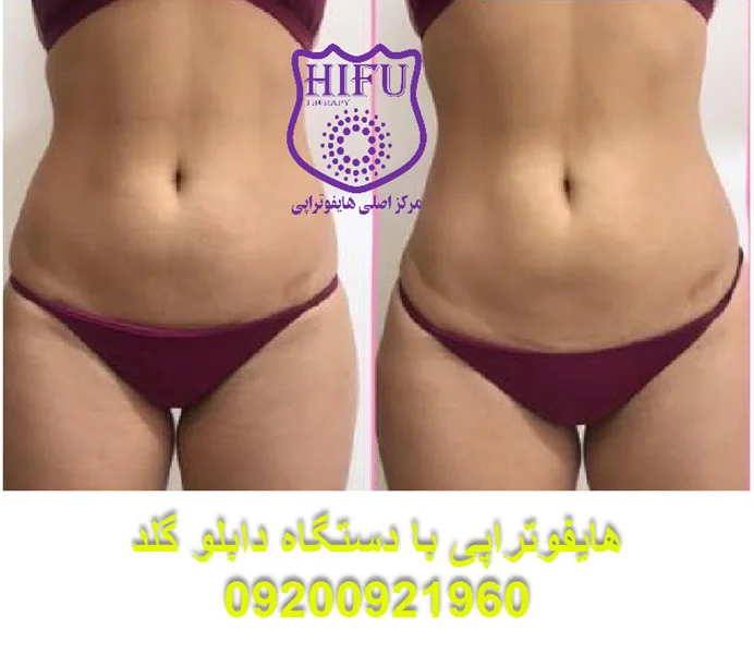 هایفوتراپی