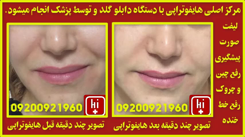 هایفوتراپی با دابلو گلد