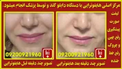 هایفوتراپی با دابلو گلد