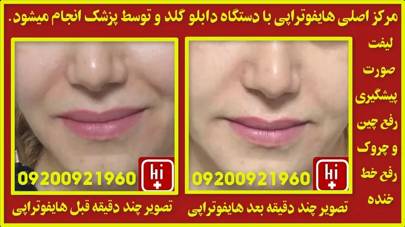 هایفوتراپی با دابلو گلد