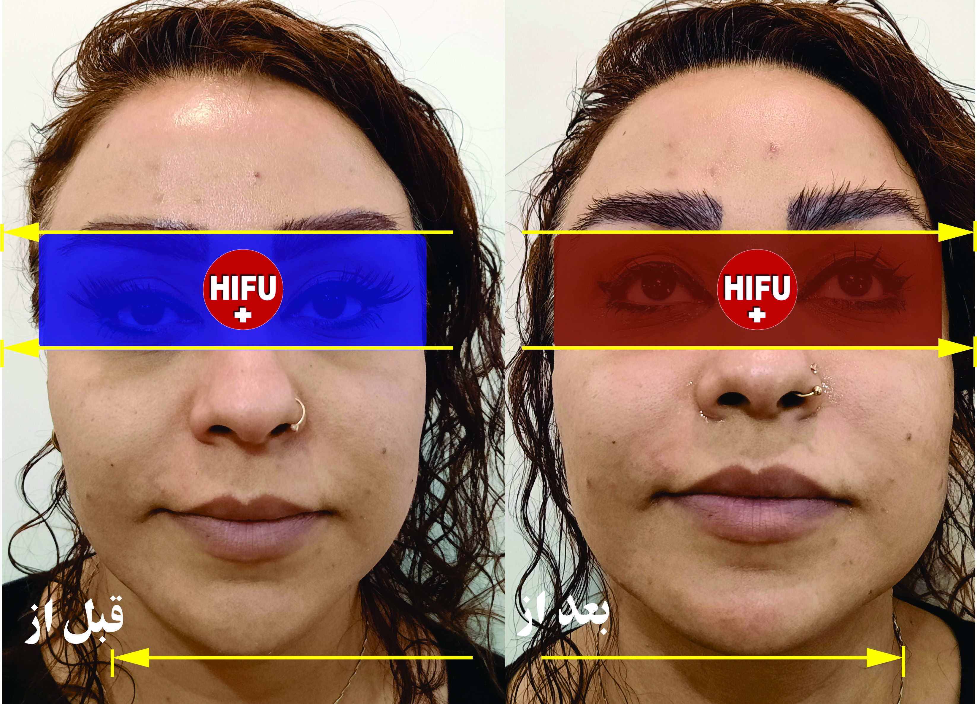 اصلی ترین روش های جوانسازی پوست صورت
