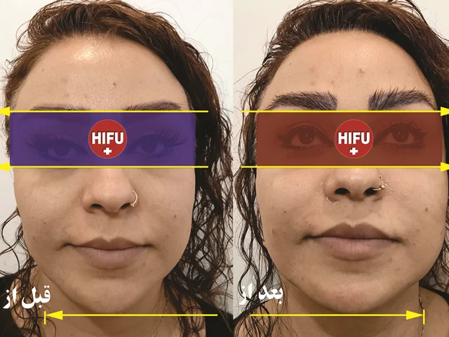 اصلی ترین روش های جوانسازی پوست صورت