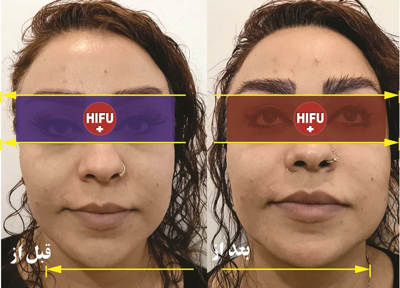 اصلی ترین روش های جوانسازی پوست صورت