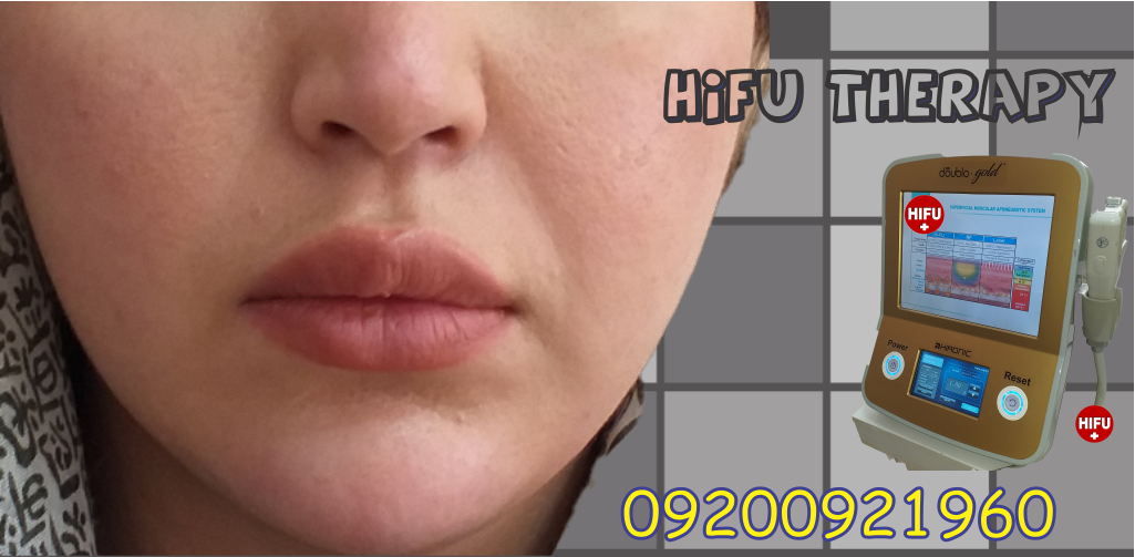 هزینه و قیمت هایفوتراپی