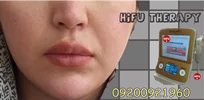 هزینه و قیمت هایفوتراپی
