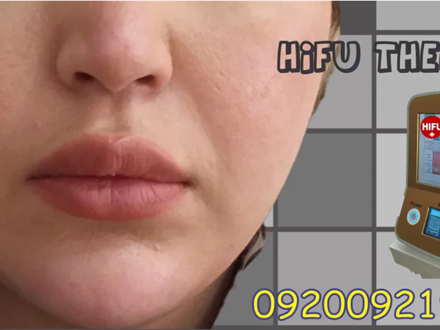 هزینه و قیمت هایفوتراپی