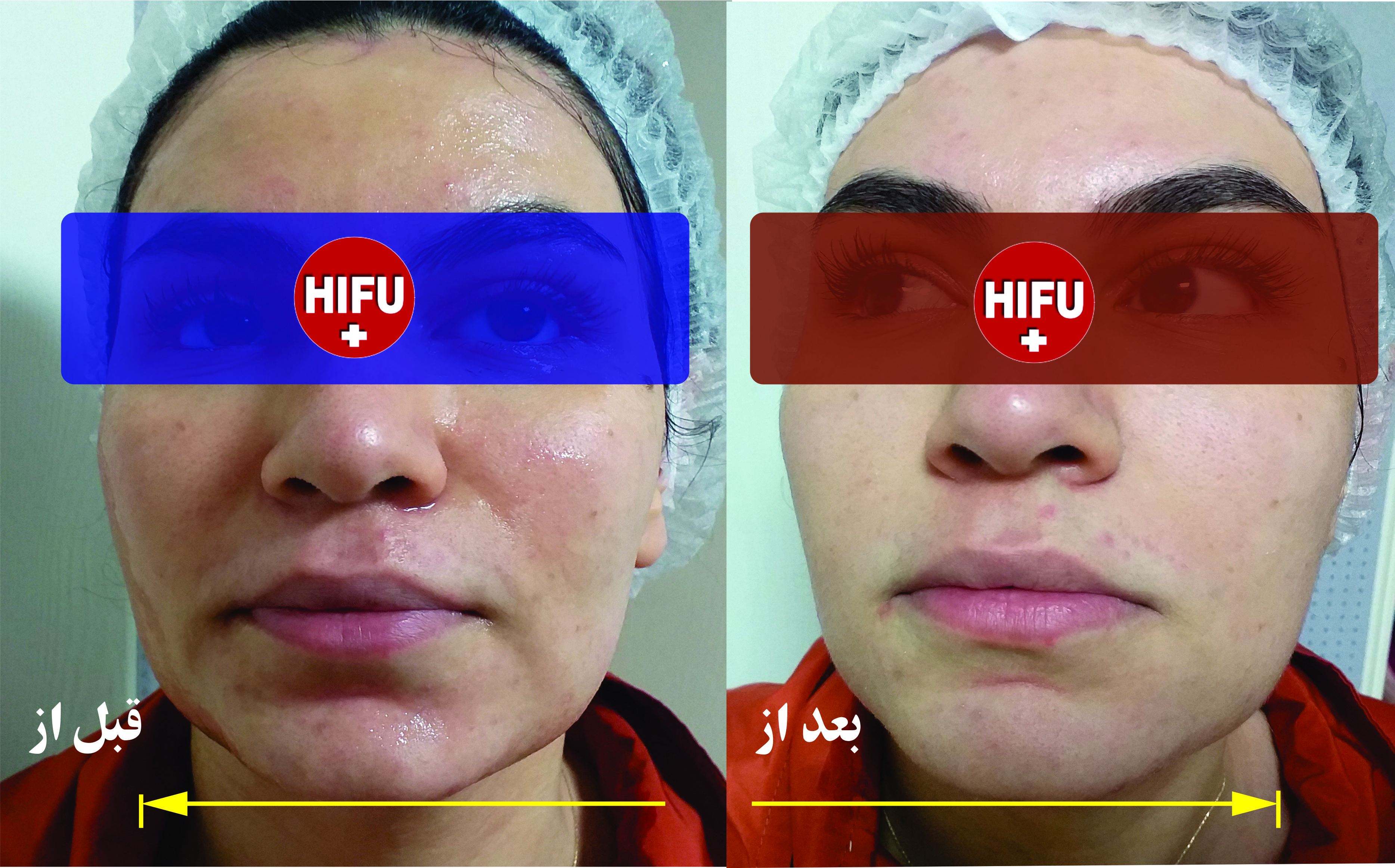 چند نکته که باید در خصوص هایفوتراپی بدانید