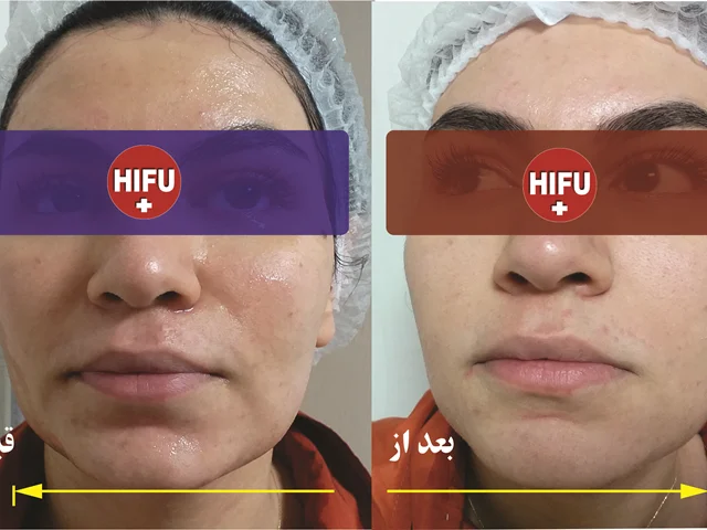 چند نکته که باید در خصوص هایفوتراپی بدانید