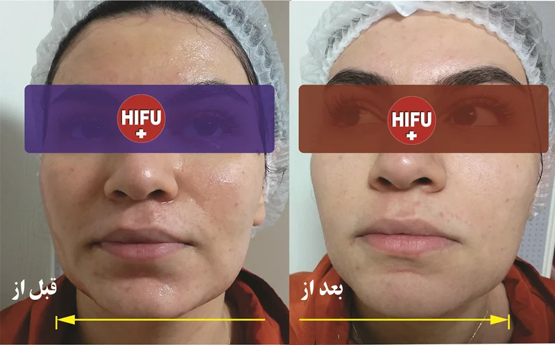 چند نکته که باید در خصوص هایفوتراپی بدانید