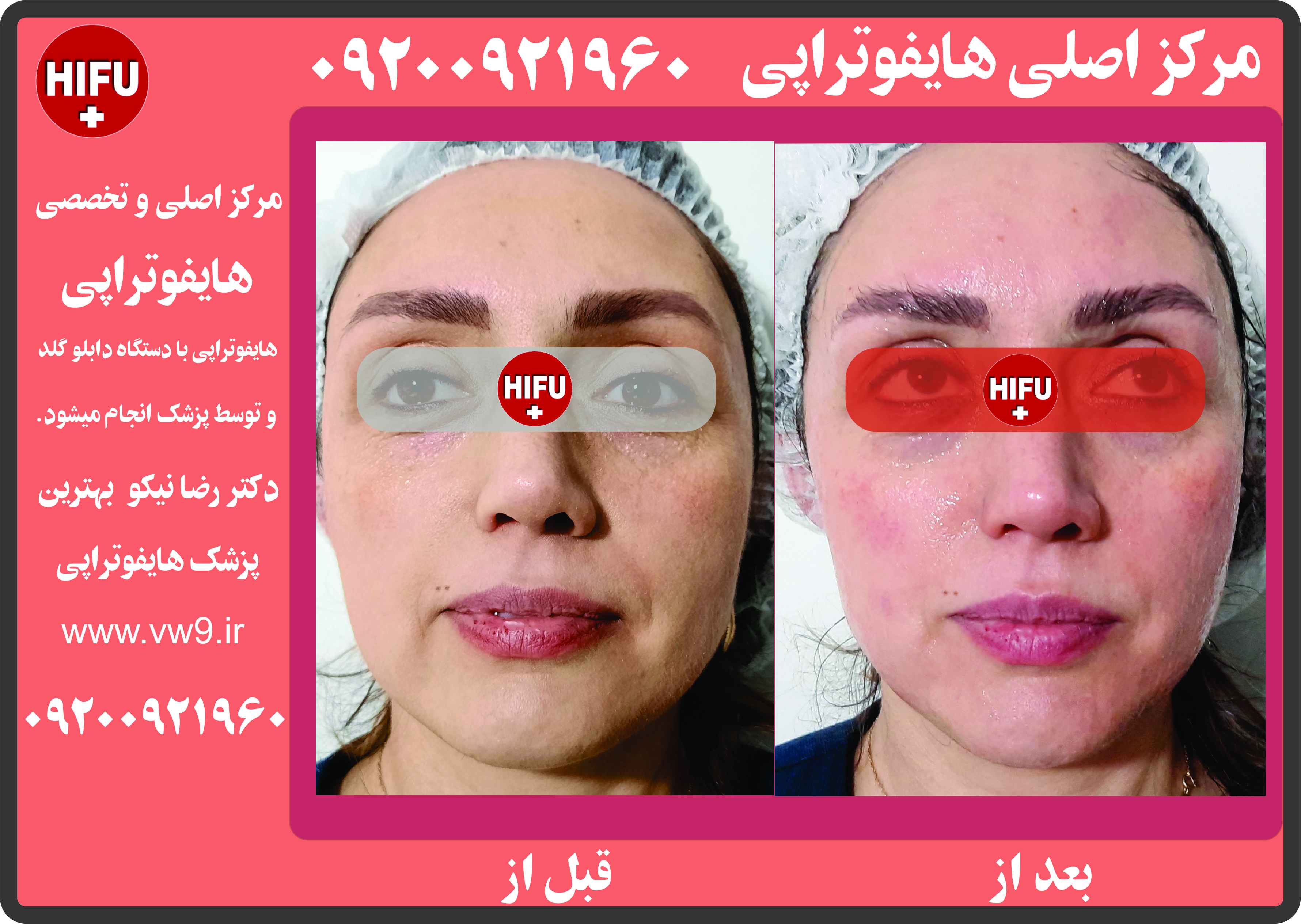 مرکز اصلی هایفوتراپی