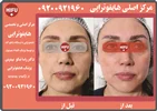 مرکز اصلی هایفوتراپی