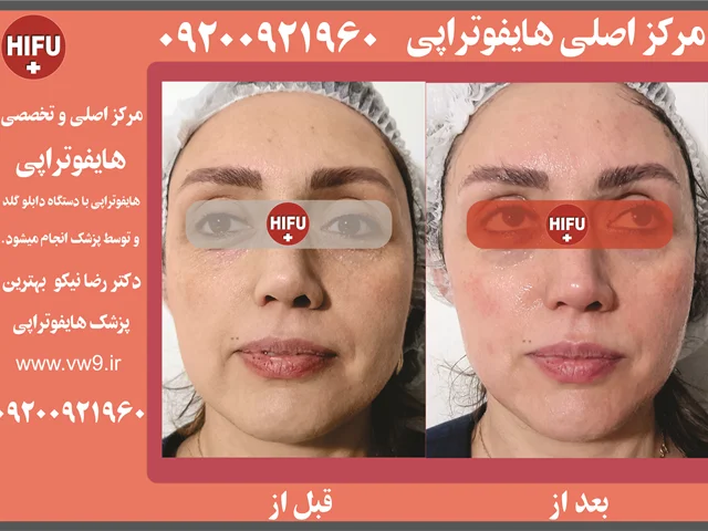 مرکز اصلی هایفوتراپی