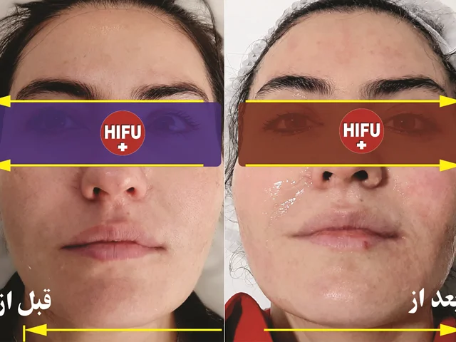 بهترین مرکز هایفوتراپی در غرب تهران