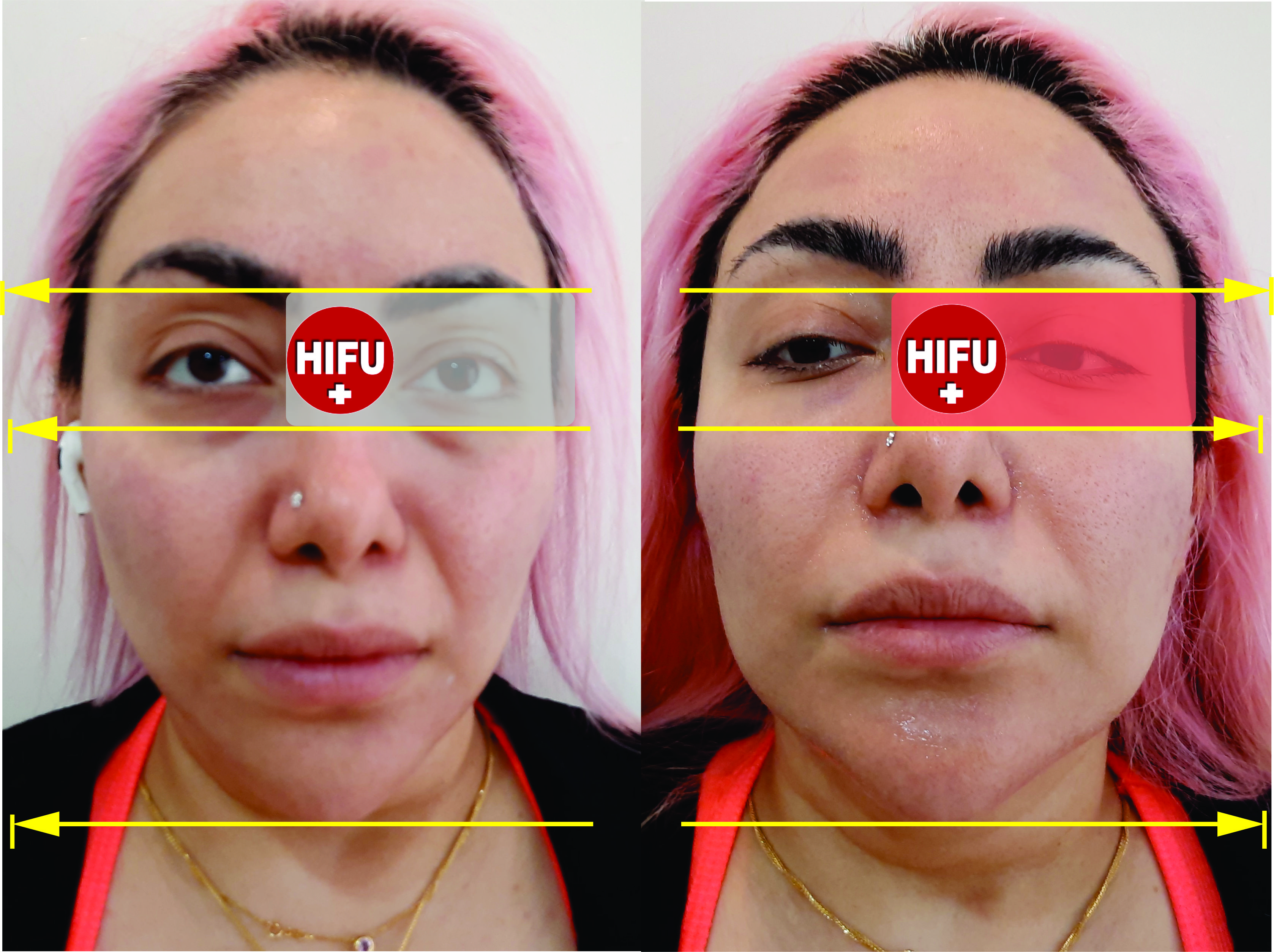 شناخت هایفوتراپی