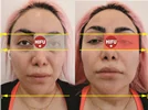 شناخت هایفوتراپی