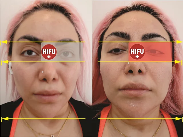 شناخت هایفوتراپی