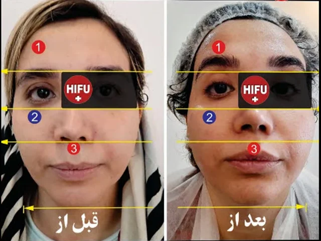 هایفوتراپی / پیشگیری و درمان / هزینه / ماندگاری