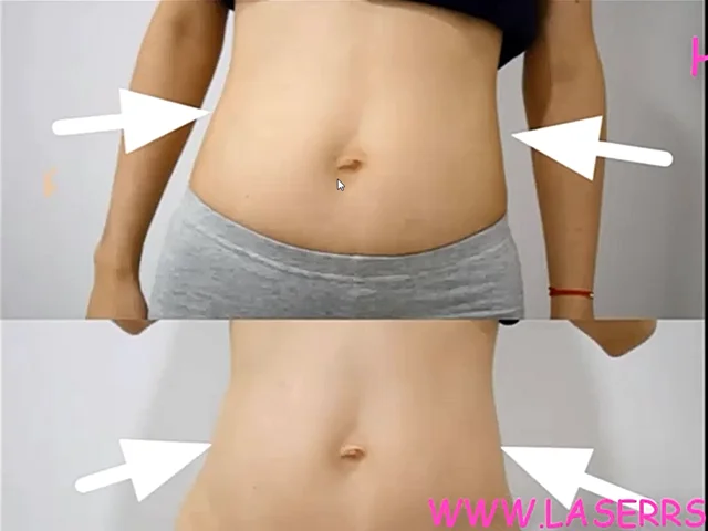 اپلیکیشن هایفوتراپی