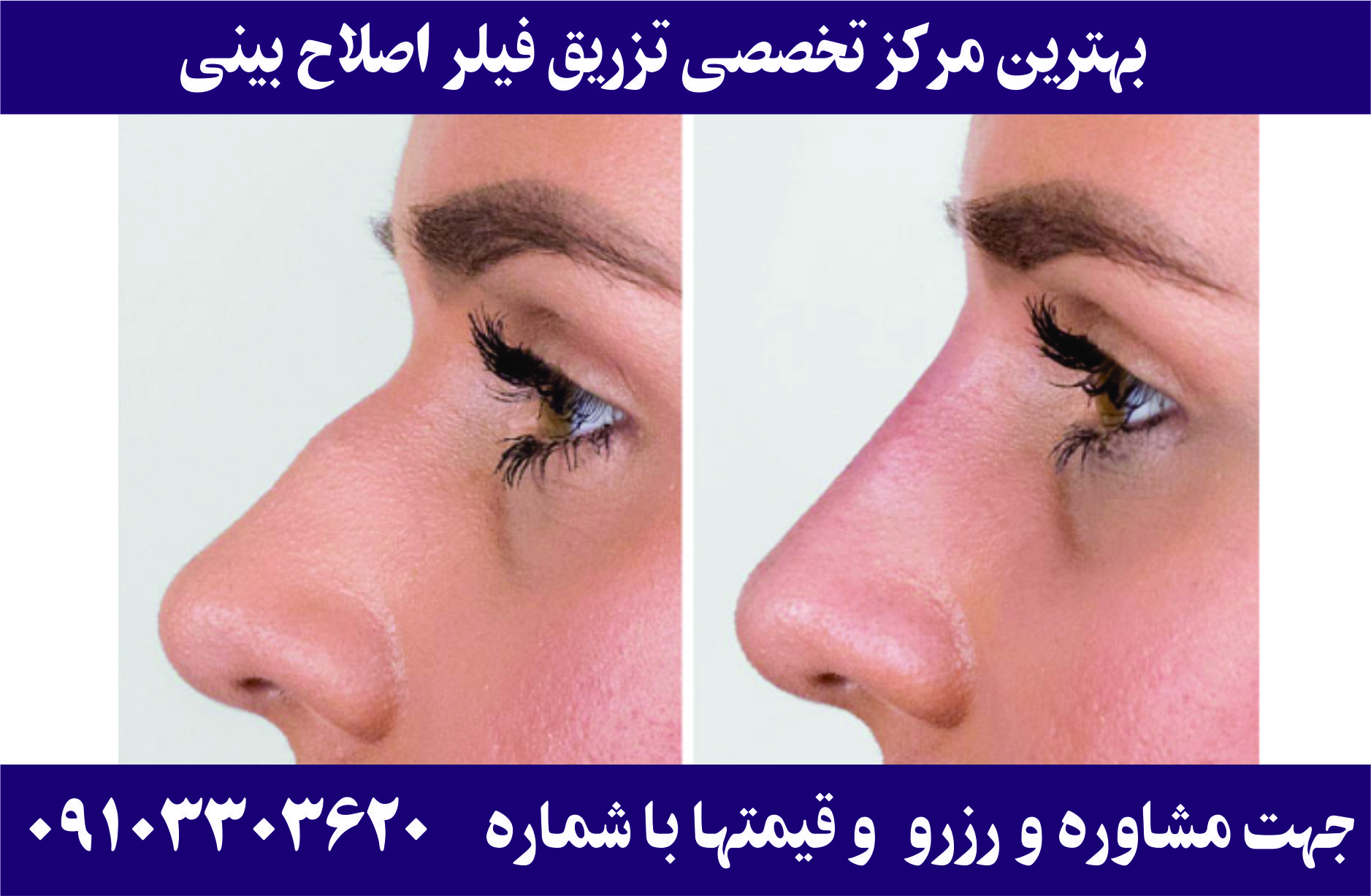 تزریق فیلر برای اصلاح فرم بینی