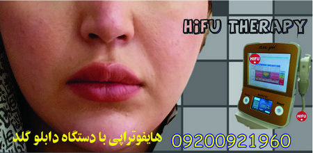 هزینه هایفو با دستگاه دابلو گلد