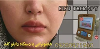 هزینه هایفو با دستگاه دابلو گلد