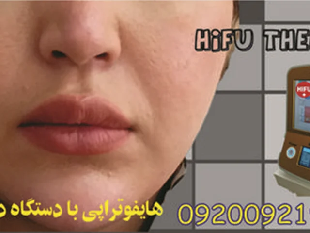 هزینه هایفو با دستگاه دابلو گلد