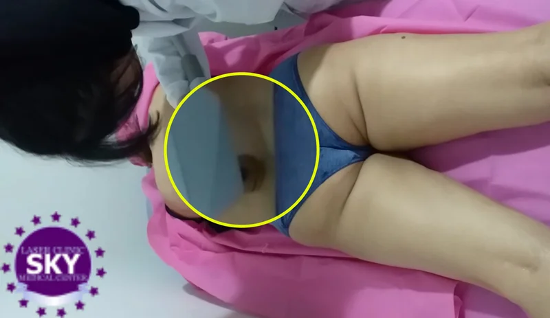 اموزش لیزر موهای زائد