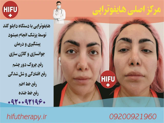 هایفوتراپی با دستگاه دابلو گلد
